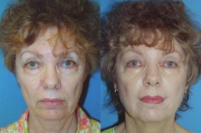 Facelift Before & After Gallery - Patient 122405782 - Image 1