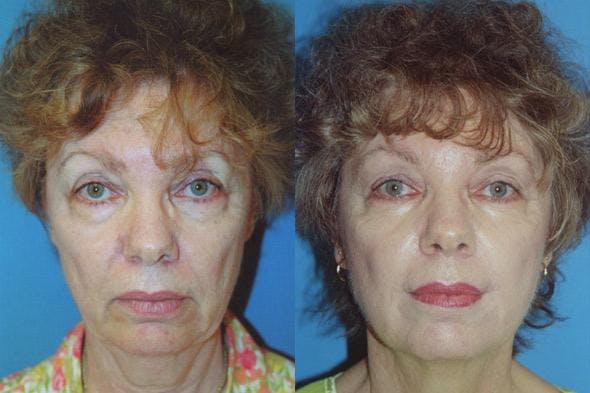 Facelift Before & After Gallery - Patient 122405782 - Image 1