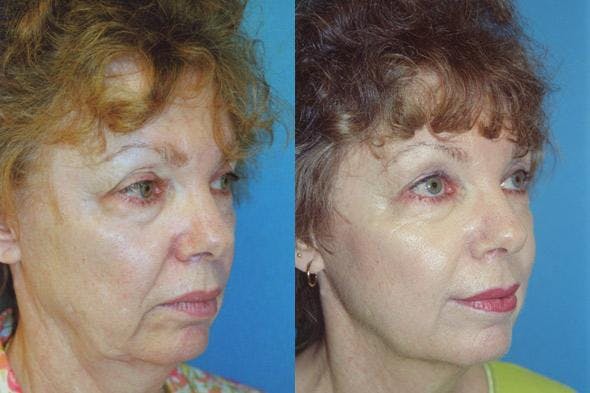 Facelift Before & After Gallery - Patient 122405782 - Image 2