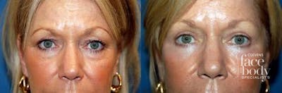 Eyelid Surgery Before & After Gallery - Patient 124241 - Image 1