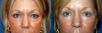 Eyelid Surgery Before & After Gallery - Patient 122405783 - Image 1