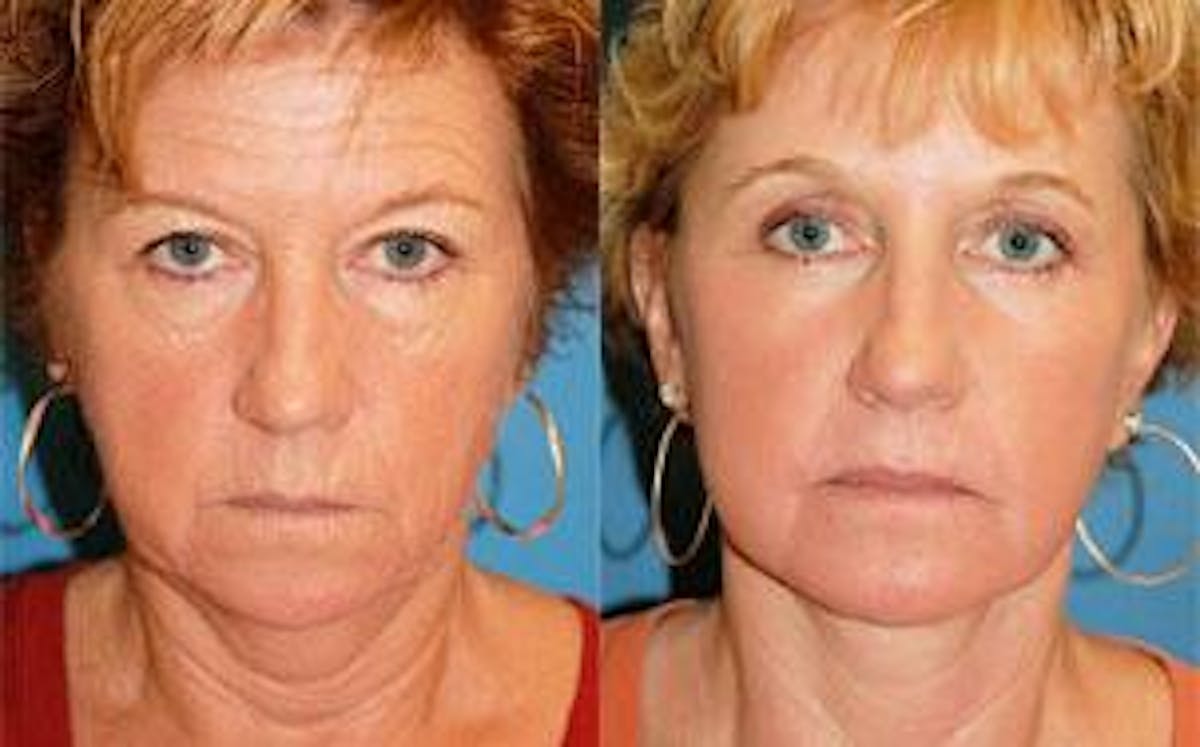 Facelift Before & After Gallery - Patient 122405784 - Image 1