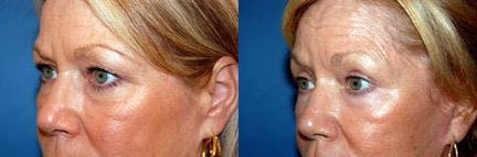 Eyelid Surgery Before & After Gallery - Patient 122405783 - Image 2