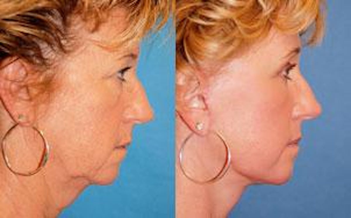 Facelift Before & After Gallery - Patient 122405784 - Image 2