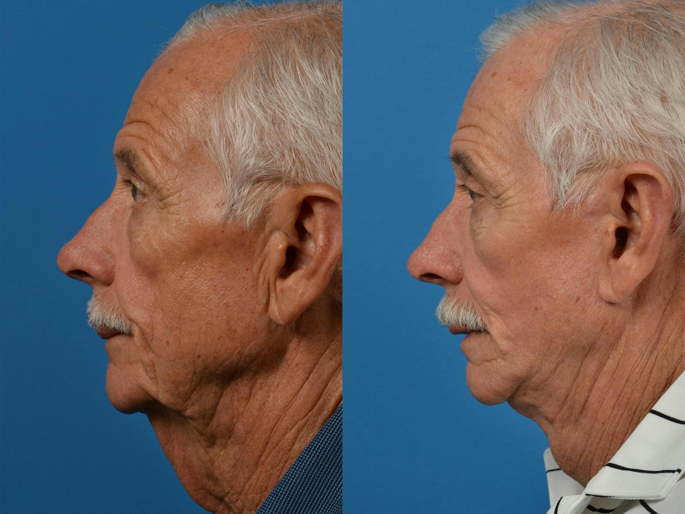 Dermal Fillers Before & After Gallery - Patient 122405788 - Image 5