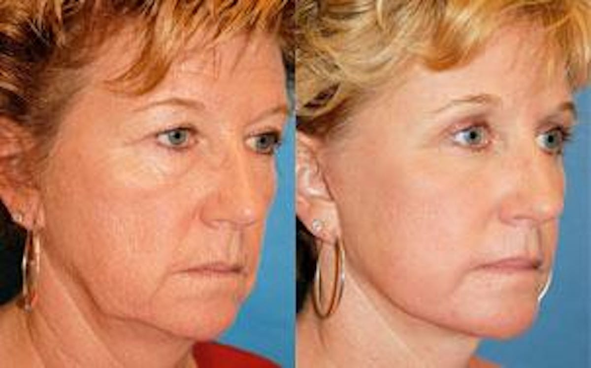 Facelift Before & After Gallery - Patient 122405784 - Image 3