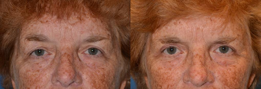 Eyelid Surgery Before & After Gallery - Patient 102390 - Image 1