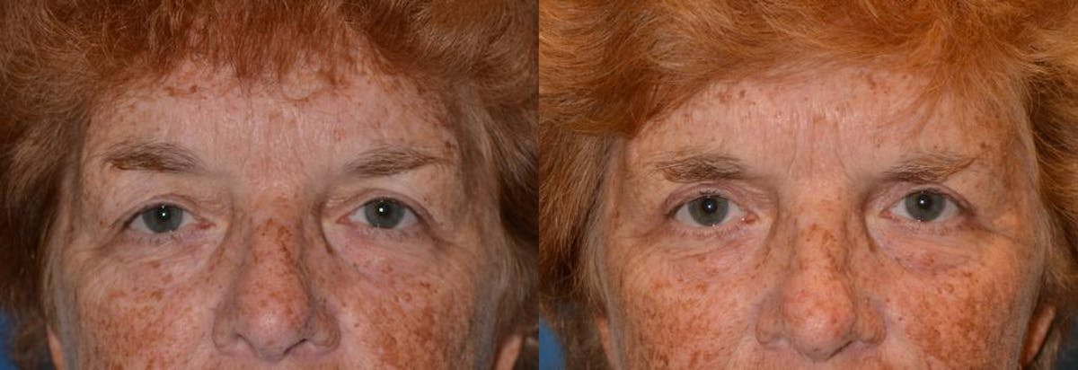 Eyelid Surgery Before & After Gallery - Patient 122405786 - Image 1
