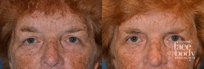 Eyelid Surgery Before & After Gallery - Patient 102390 - Image 1