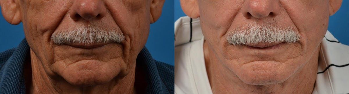 Dermal Fillers Before & After Gallery - Patient 122405788 - Image 6