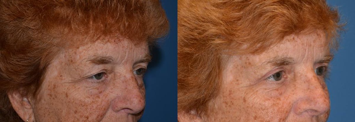 Eyelid Surgery Before & After Gallery - Patient 122405786 - Image 2