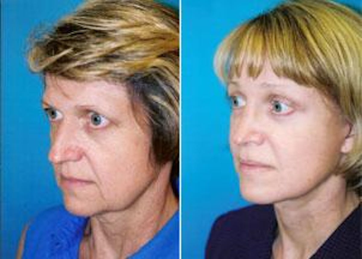Facelift Before & After Gallery - Patient 122405785 - Image 1