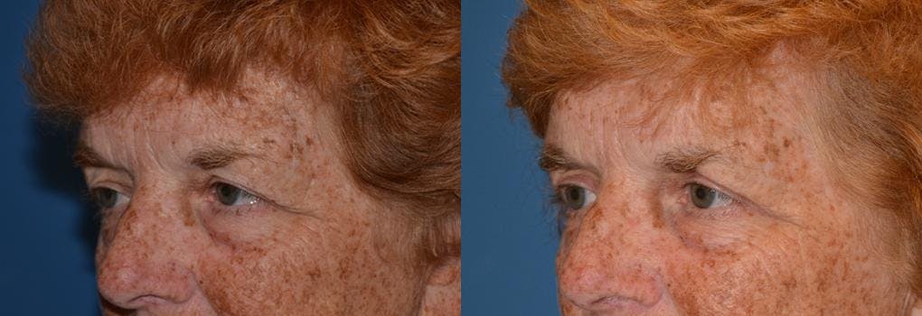 Eyelid Surgery Before & After Gallery - Patient 122405786 - Image 3