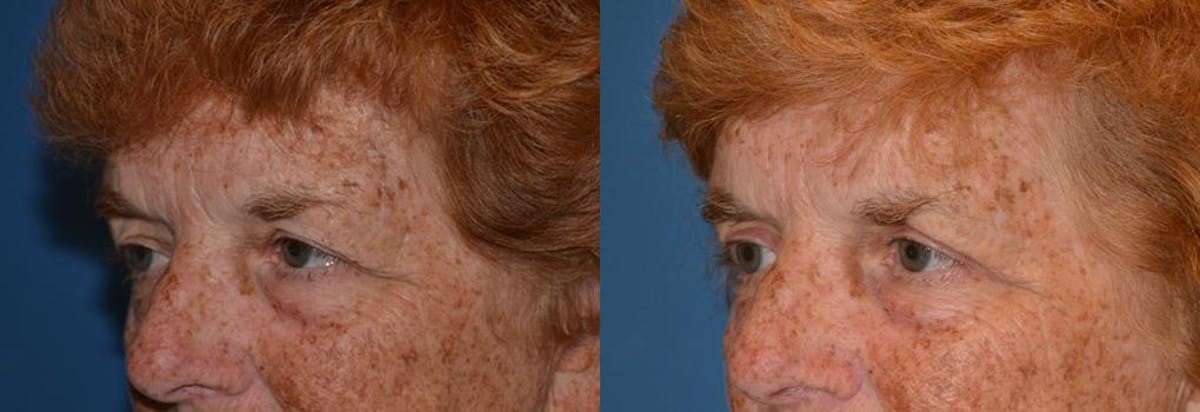 Eyelid Surgery Before & After Gallery - Patient 122405786 - Image 3