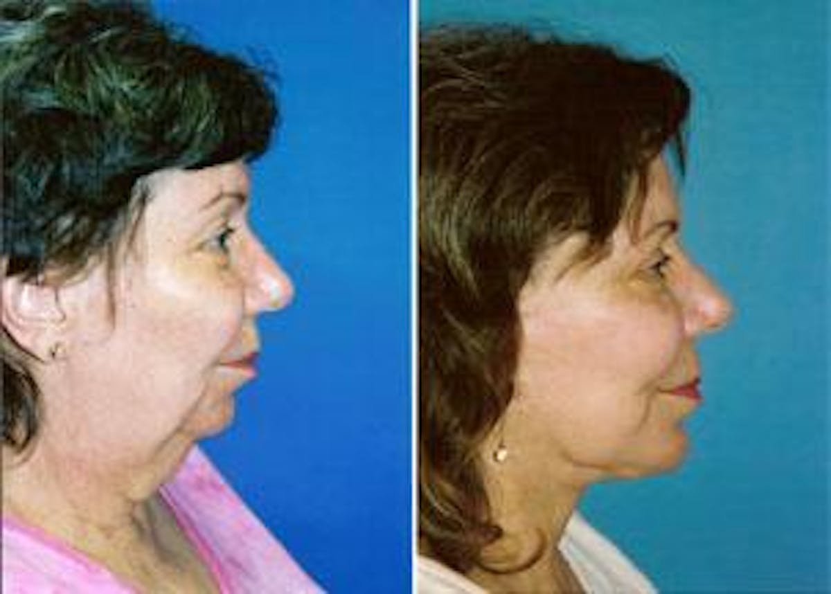 Facelift Before & After Gallery - Patient 122405787 - Image 1