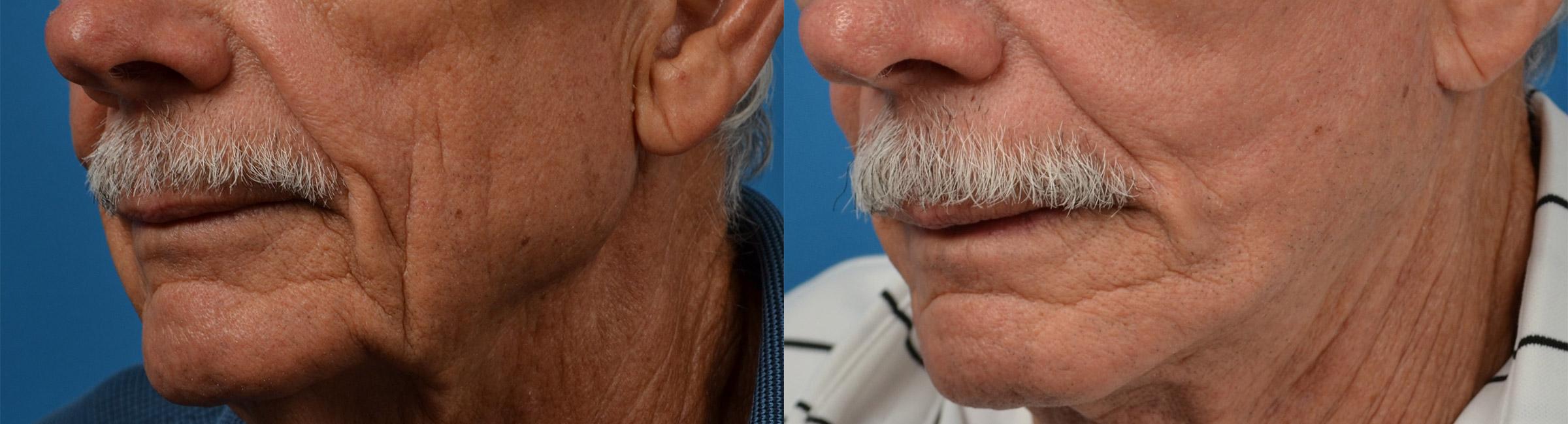 Dermal Fillers Before & After Gallery - Patient 122405788 - Image 8