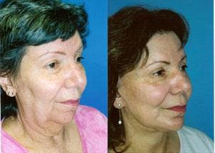 Facelift Before & After Gallery - Patient 122405787 - Image 2