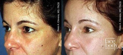 Eyelid Surgery Before & After Gallery - Patient 155808 - Image 1