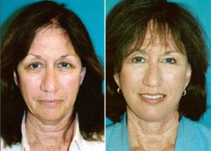 Facelift Before & After Gallery - Patient 122405792 - Image 1