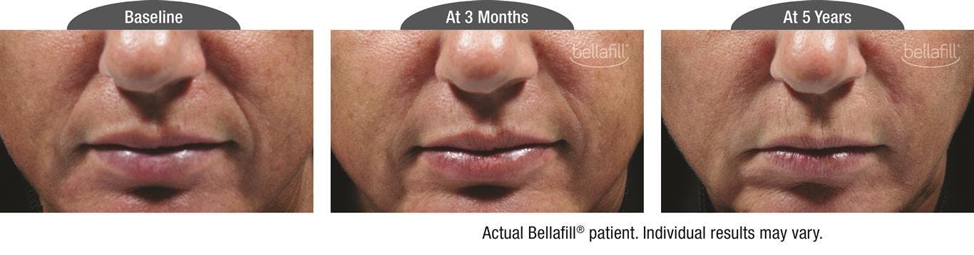 Dermal Fillers Before & After Gallery - Patient 122405791 - Image 1