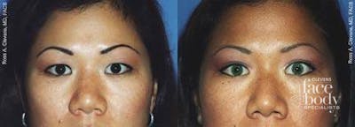 Eyelid Surgery Before & After Gallery - Patient 279552 - Image 1