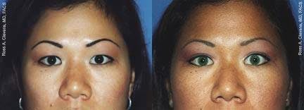 Eyelid Surgery Before & After Gallery - Patient 122405790 - Image 1