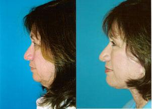 Facelift Before & After Gallery - Patient 122405792 - Image 2