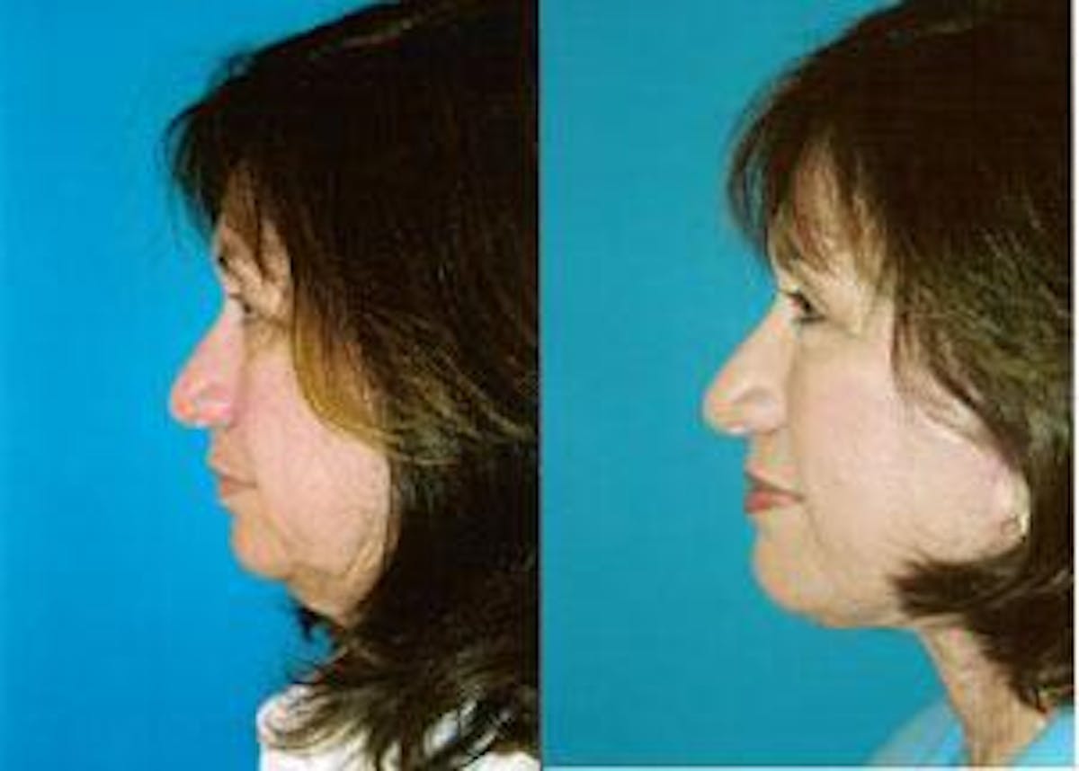Facelift Before & After Gallery - Patient 122405792 - Image 2
