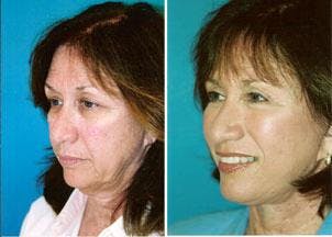 Facelift Before & After Gallery - Patient 122405792 - Image 3