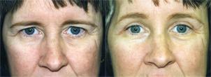 Eyelid Surgery Before & After Gallery - Patient 301449 - Image 1