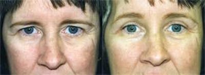 Eyelid Surgery Before & After Gallery - Patient 122405794 - Image 1