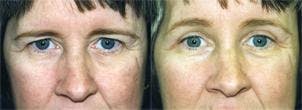 Eyelid Surgery Before & After Gallery - Patient 122405794 - Image 1