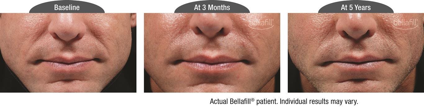 Dermal Fillers Before & After Gallery - Patient 122405793 - Image 1