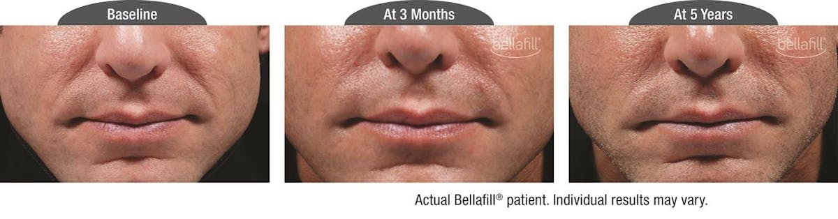 Dermal Fillers Before & After Gallery - Patient 122405793 - Image 1