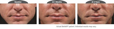 Dermal Fillers Before & After Gallery - Patient 122405793 - Image 1