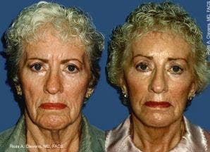 Facelift Before & After Gallery - Patient 122405795 - Image 1