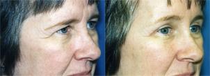 Eyelid Surgery Before & After Gallery - Patient 301449 - Image 2