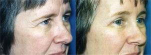Eyelid Surgery Before & After Gallery - Patient 122405794 - Image 2