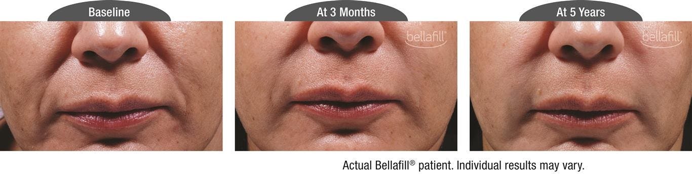 Dermal Fillers Before & After Gallery - Patient 122405796 - Image 1