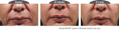 Dermal Fillers Before & After Gallery - Patient 122405796 - Image 1