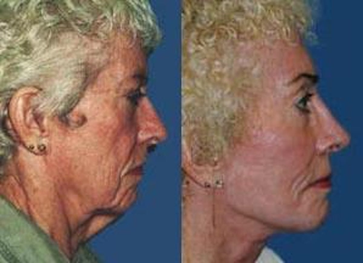 Facelift Before & After Gallery - Patient 122405795 - Image 2