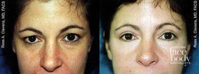 Eyelid Surgery Before & After Gallery - Patient 362726 - Image 1