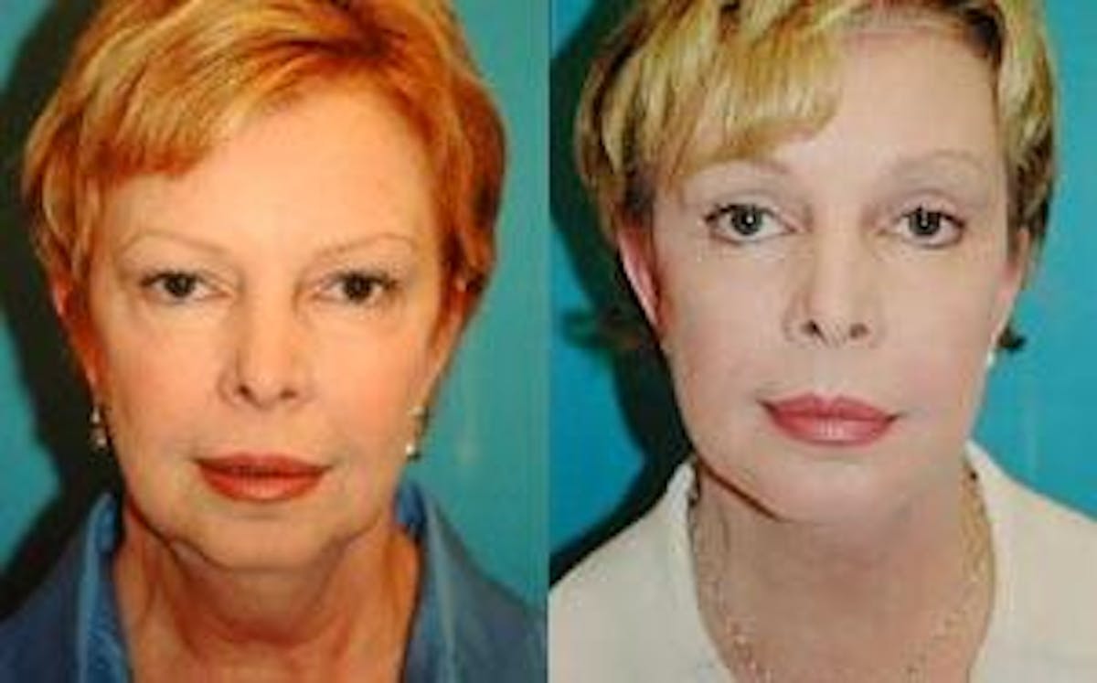 Facelift Before & After Gallery - Patient 122405802 - Image 1