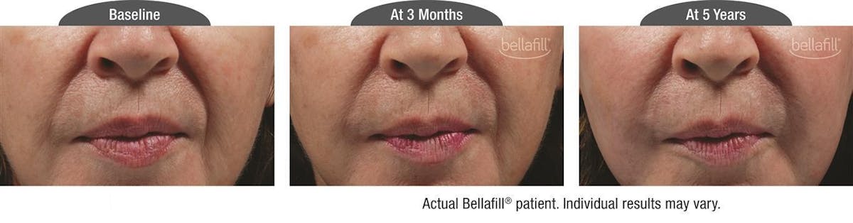 Dermal Fillers Before & After Gallery - Patient 122405799 - Image 1