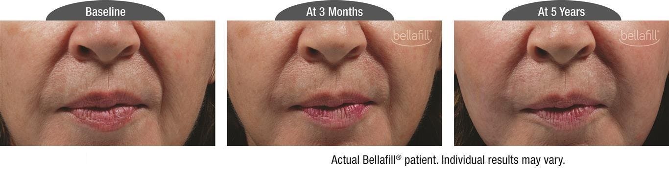 Dermal Fillers Before & After Gallery - Patient 122405799 - Image 1