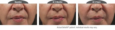 Dermal Fillers Before & After Gallery - Patient 122405799 - Image 1