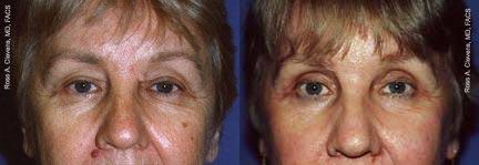 Eyelid Surgery Before & After Gallery - Patient 267470 - Image 1