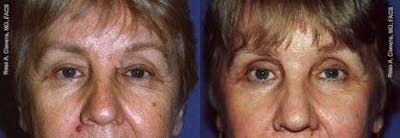 Eyelid Surgery Before & After Gallery - Patient 122405798 - Image 1