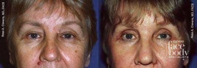 Eyelid Surgery Before & After Gallery - Patient 267470 - Image 1