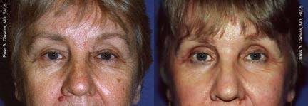 Eyelid Surgery Before & After Gallery - Patient 122405798 - Image 1